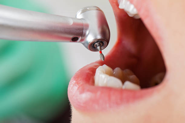 Best Emergency Root Canal Treatment in Belmont, NC